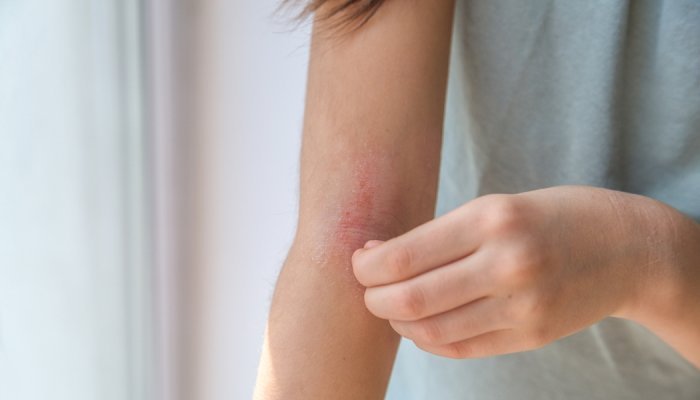 ANVISA torna obrigatório notificar eventos adversos graves com cosméticos