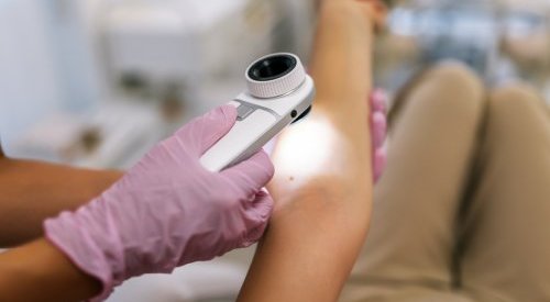 Raios UV causam 80% dos melanomas no mundo, segundo agência da OMS