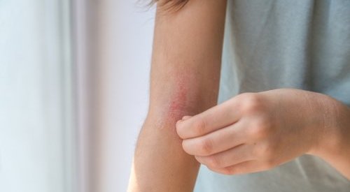 ANVISA torna obrigatório notificar eventos adversos graves com cosméticos