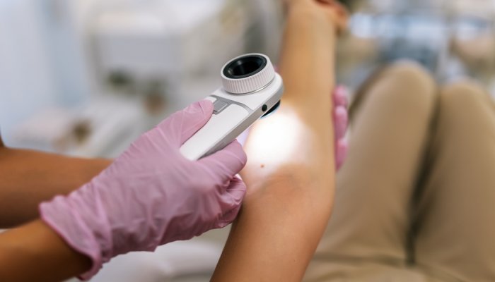 Raios UV causam 80% dos melanomas no mundo, segundo agência da OMS