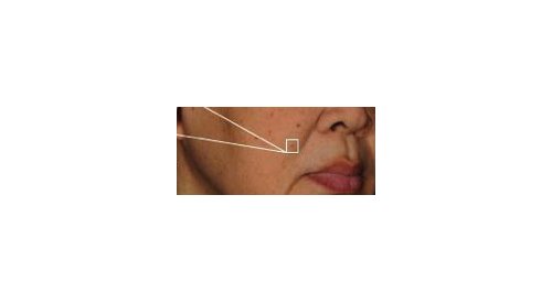 Gattefossé: 360° action on UV-induced hyperpigmentation